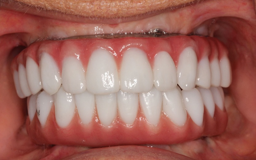 After AccuFrame Overdenture Installation